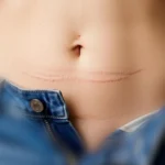 Liposuction in Dubai with Dr Babak Hatami: an advanced approach to body contouring